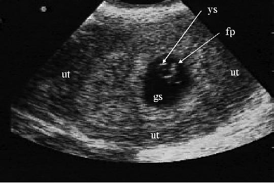 Внематочная эндометрий. Внематочная беременность 6 недель УЗИ. Внематочная беременность 5-6 недель УЗИ. 4 5 Недель беременности УЗИ внематочная. УЗИ внематочной беременности 5 недель.