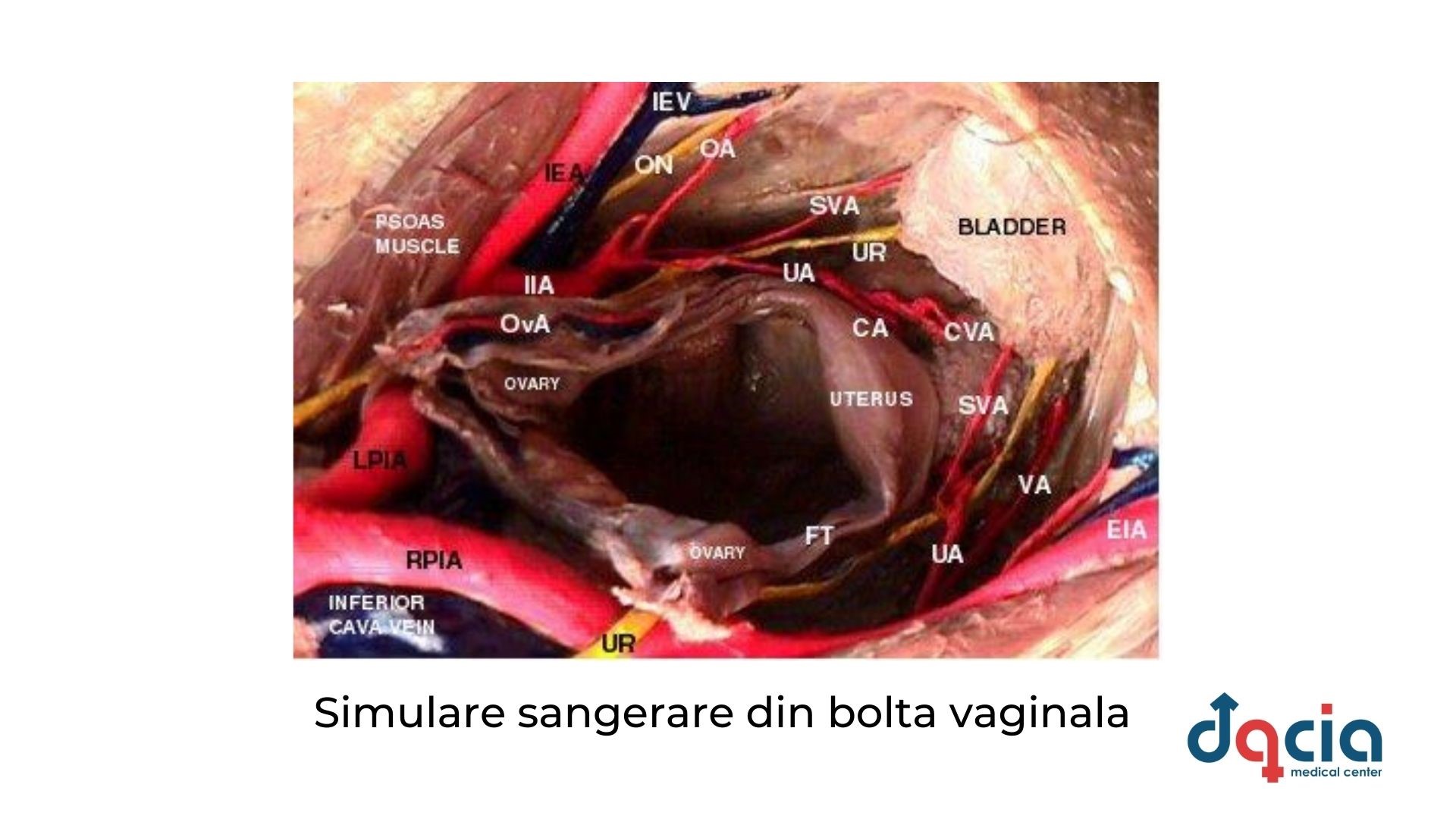 sangerare din bolta vaginala - riscuri ale fertilizarii in vitro