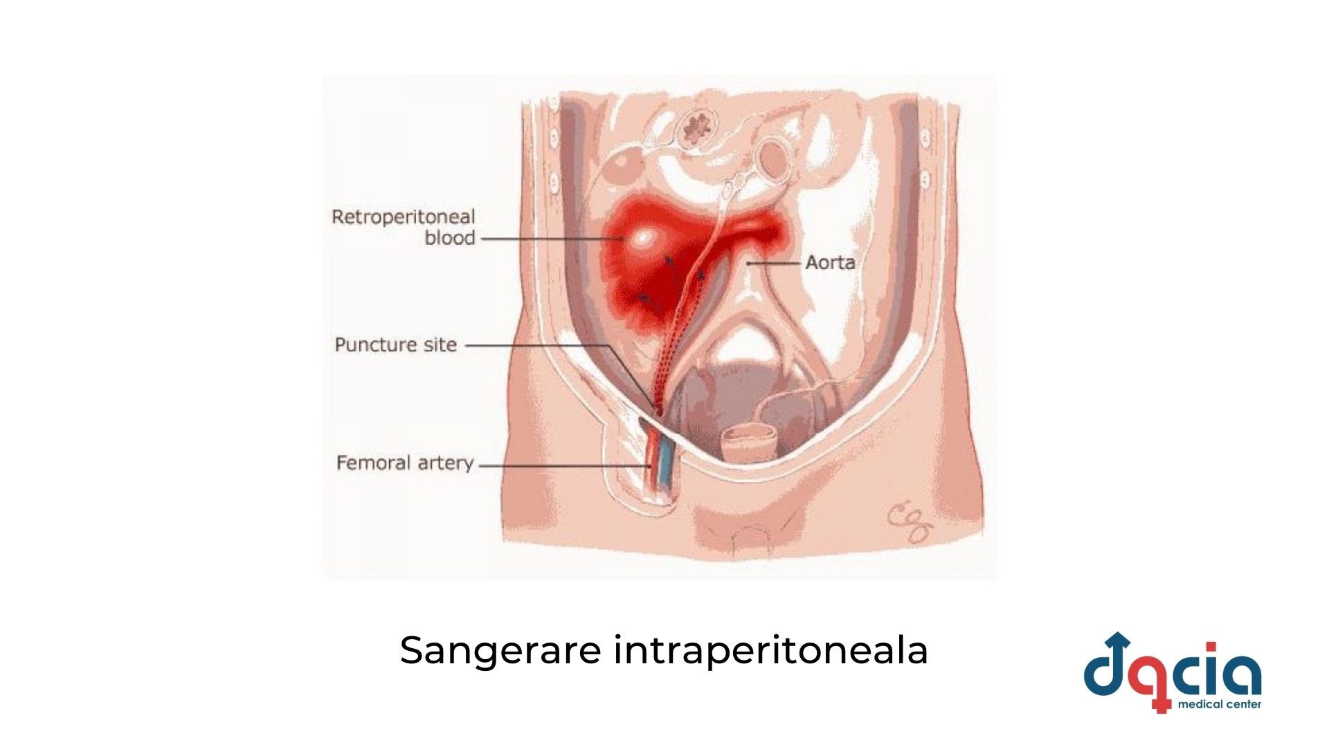 sangerare intraperitoneala - riscuri ale fertilizarii in vitro 