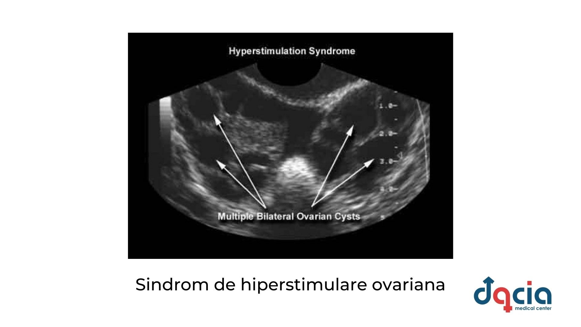 riscuri ale fertilizarii in vitro - sindrom de hiperstimulare ovariana 